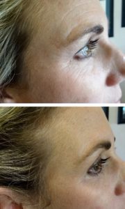 before-after-3